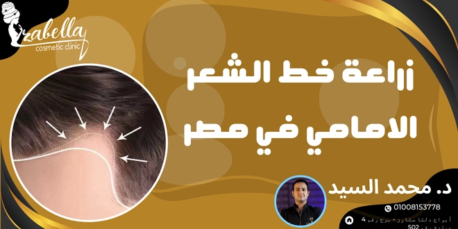 زراعة خط الشعر الامامي في مصر